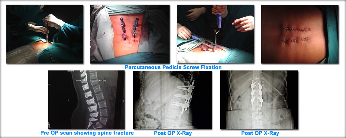 minimally-invasive-spine-surgery