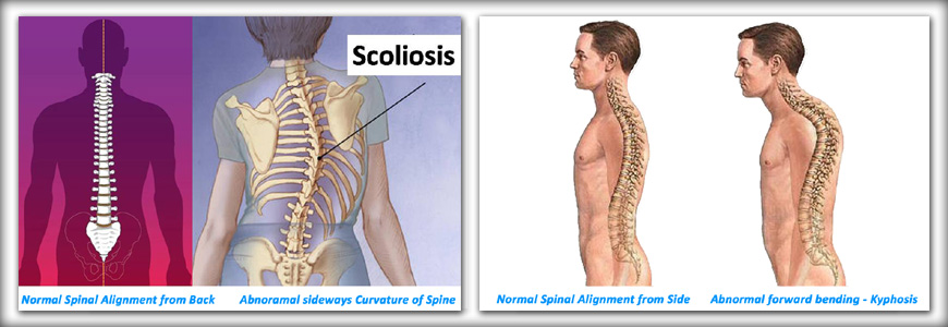 spinal-deformity-intro