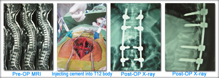 spinal-tumours-case-1