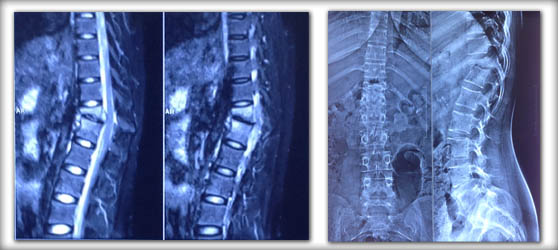 spine-infection